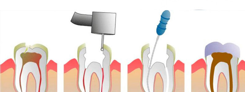 Root Canal