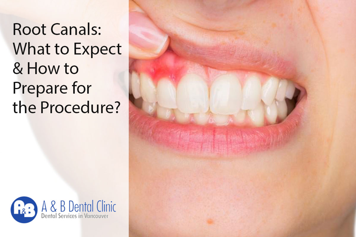 Root Canals: What to Expect & How to Prepare for the Procedure?