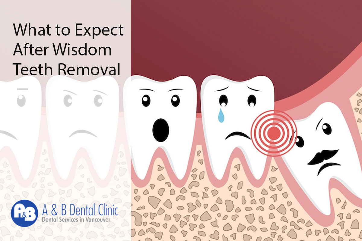 What to Expect After Wisdom Teeth Removal