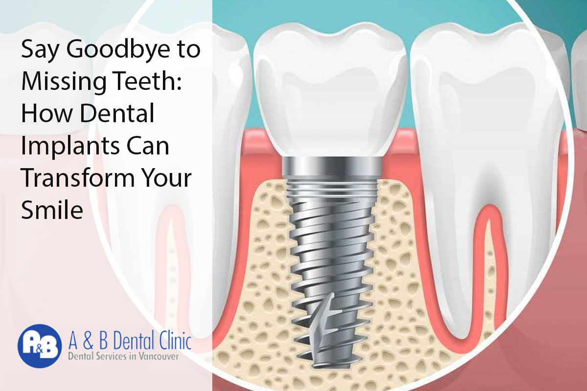 Say Goodbye to Missing Teeth: How Dental Implants Can Transform Your Smile