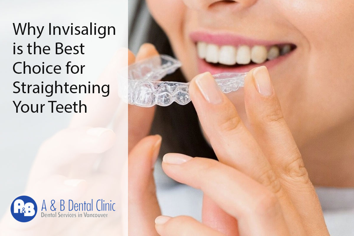 Why Invisalign is the Best Choice for Straightening Your Teeth