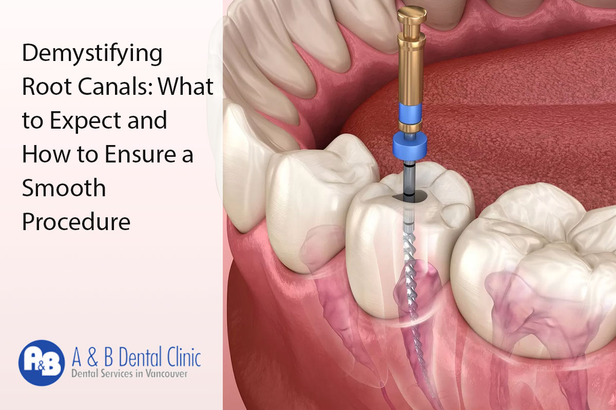 Demystifying Root Canals: What to Expect and How to Ensure a Smooth Procedure