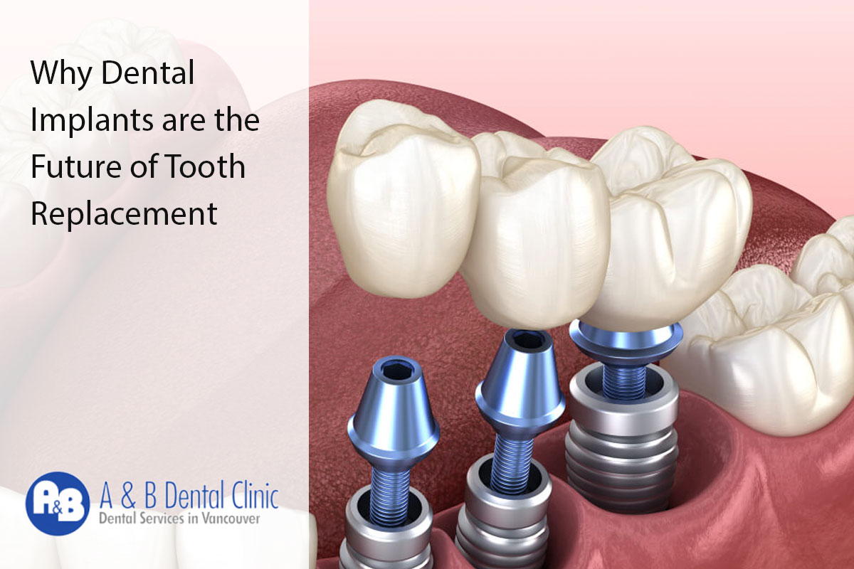Why Dental Implants are the Future of Tooth Replacement