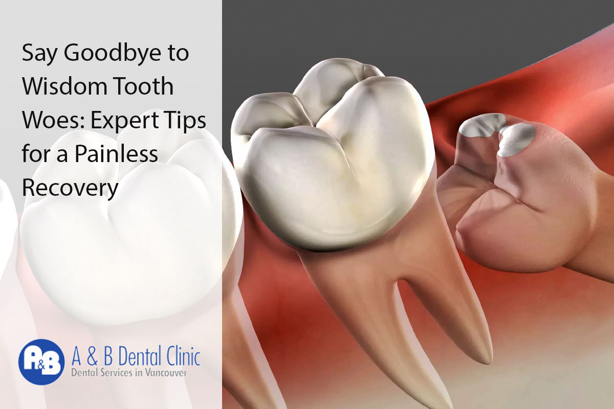 Say Goodbye to Wisdom Tooth Woes: Expert Tips for a Painless Recovery