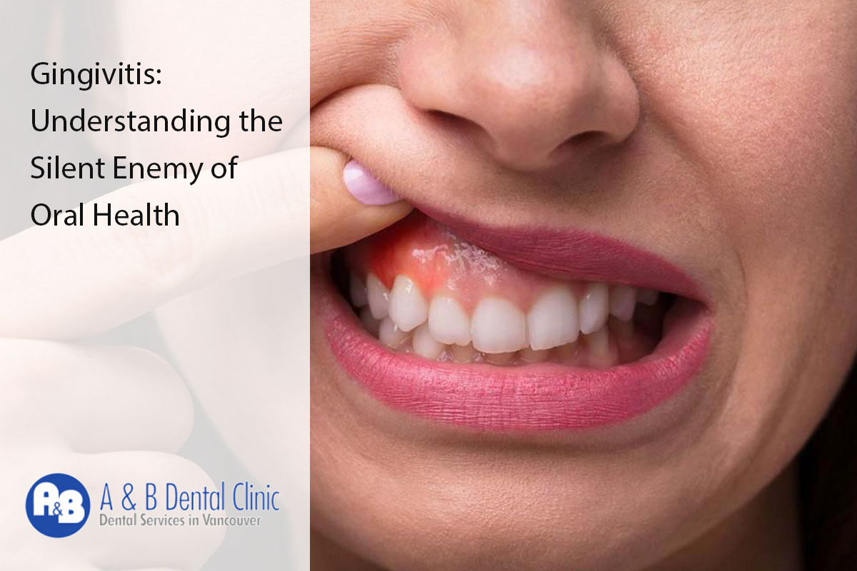 Gingivitis: Understanding the Silent Enemy of Oral Health