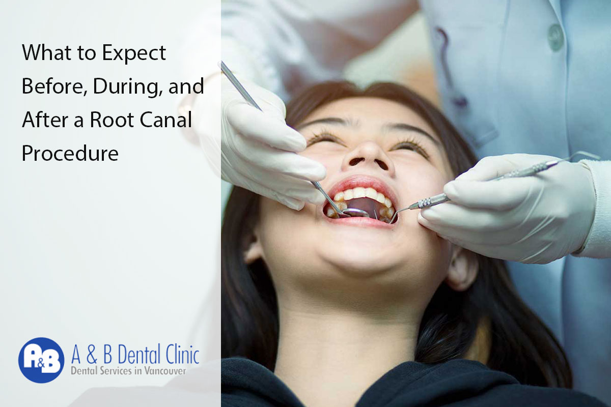 What to Expect Before, During, and After a Root Canal Procedure