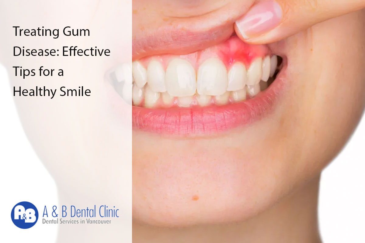Treating Gum Disease: Effective Tips for a Healthy Smile