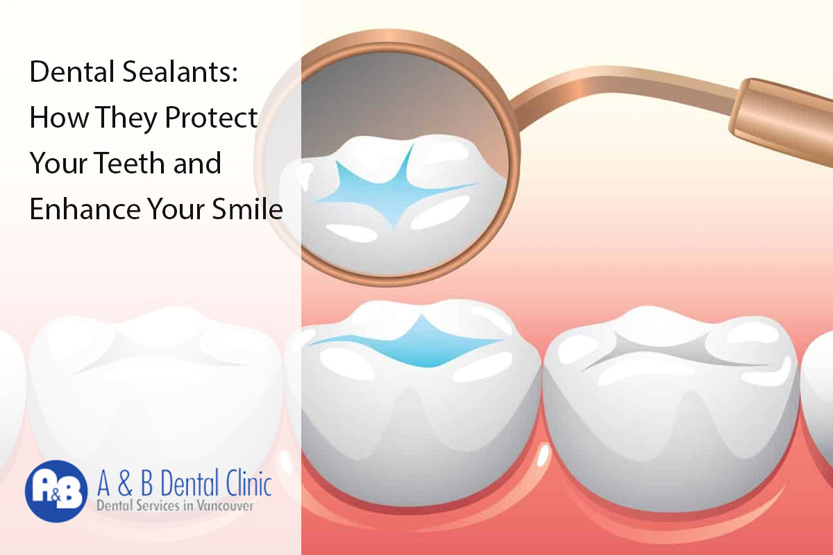 Dental Sealants: How They Protect Your Teeth and Enhance Your Smile