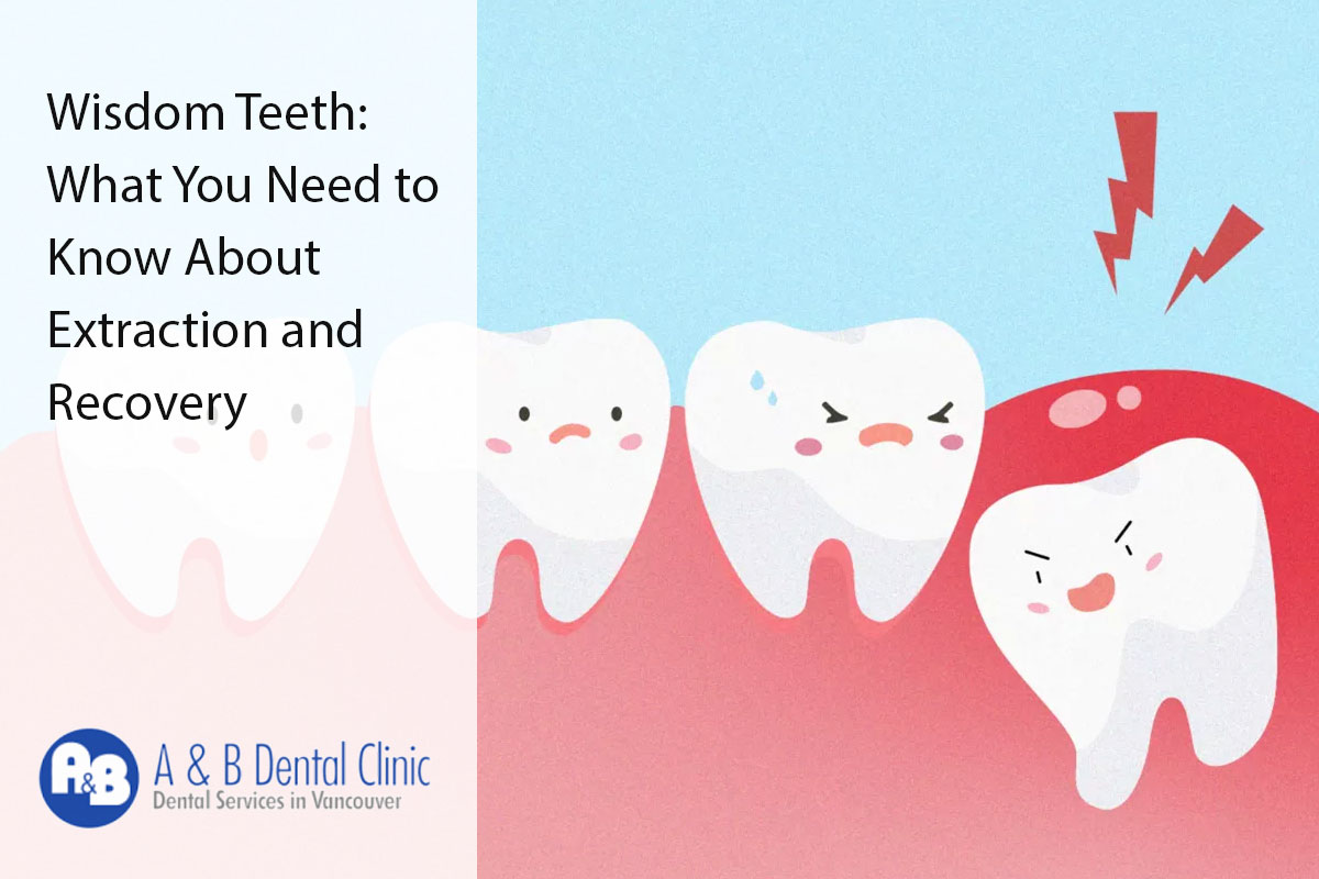 Wisdom Teeth: What You Need to Know About Extraction and Recovery