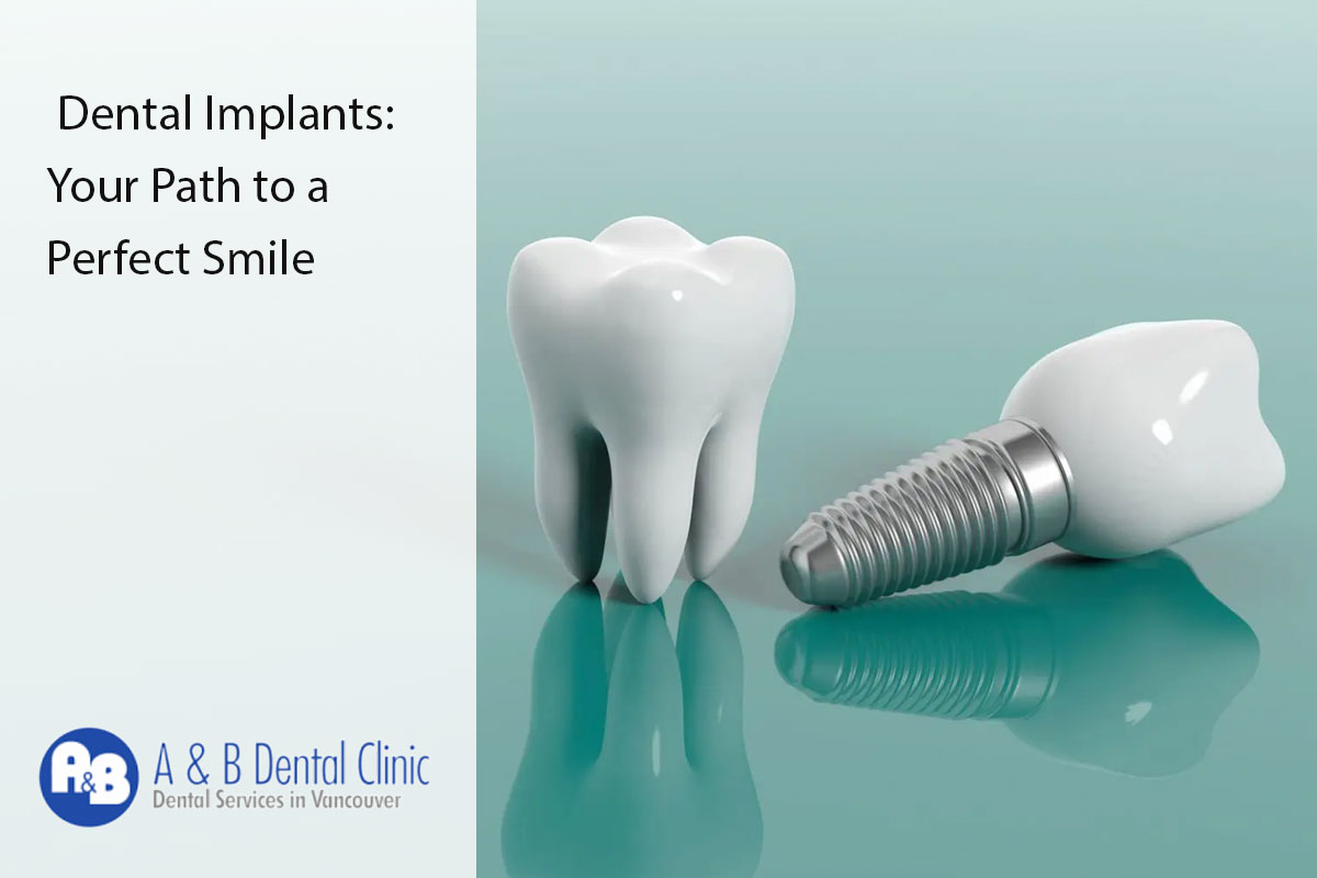 Dental Implants: Your Path to a Perfect Smile