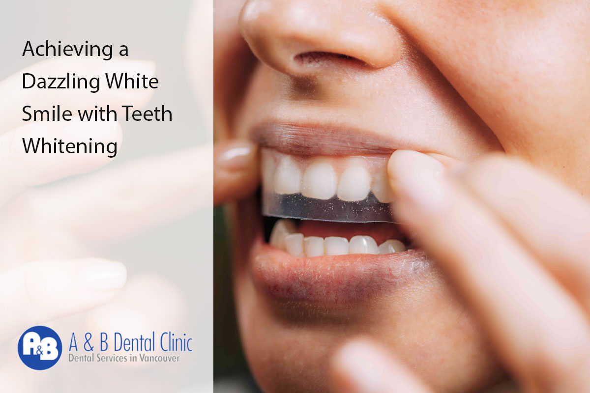 Achieving a Dazzling White Smile with Teeth Whitening