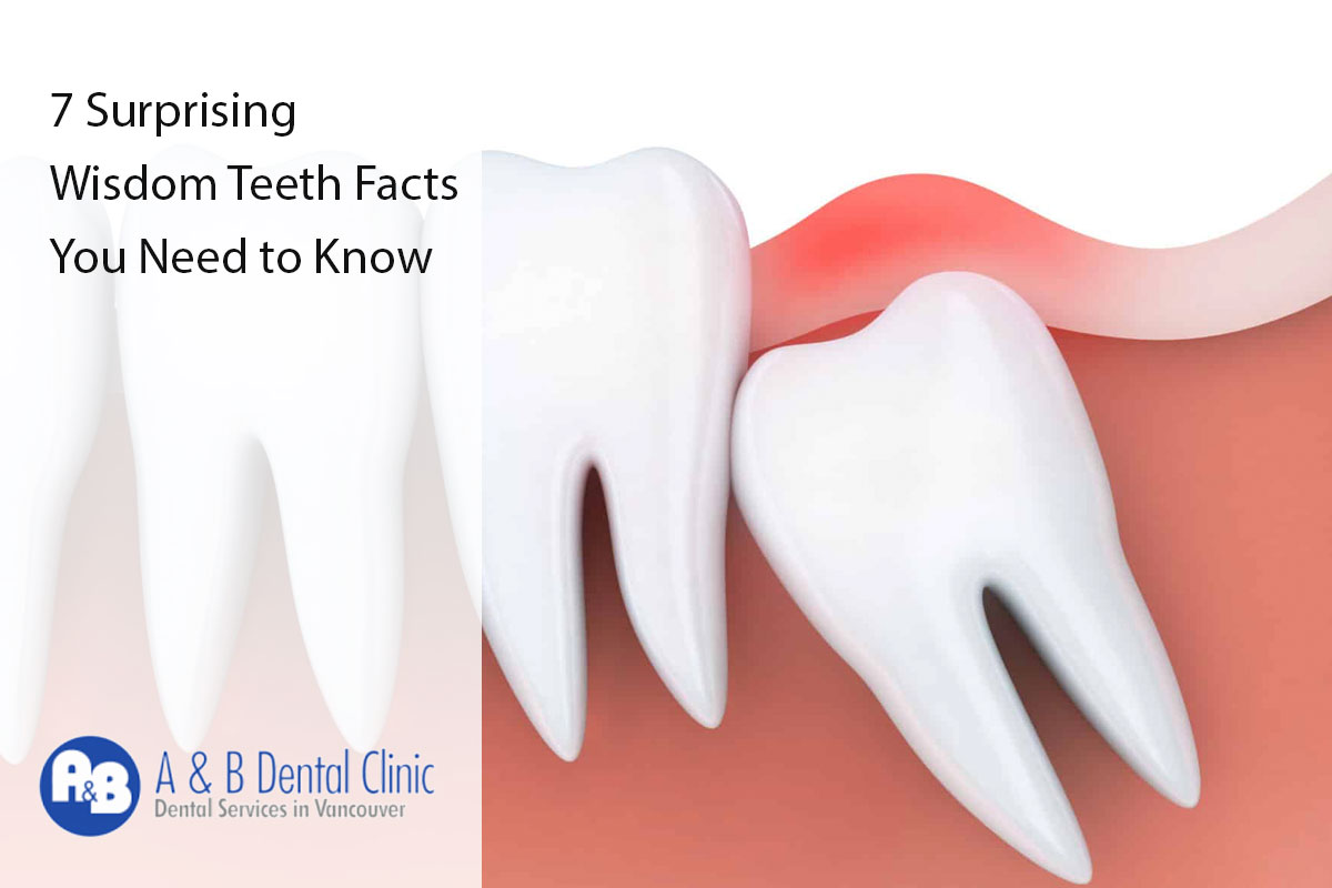 7 Surprising Wisdom Teeth Facts You Need to Know - AB Dental Clinic